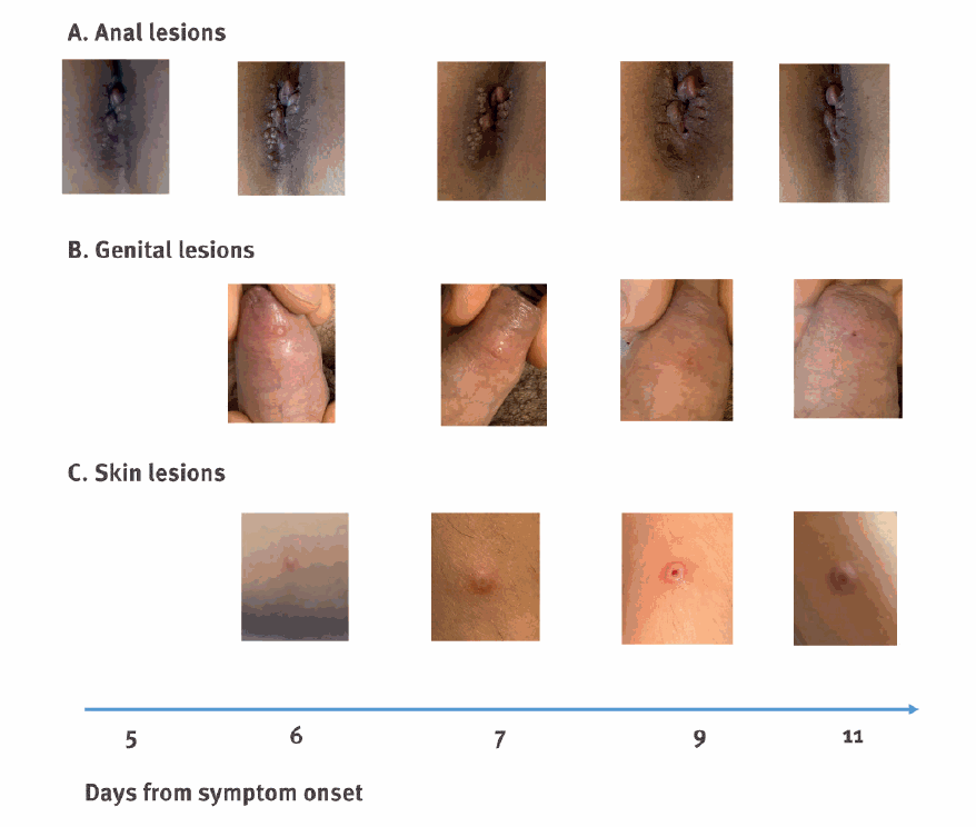 How does monkeypox start? Plus, 5 pictures to show how the bumps progress