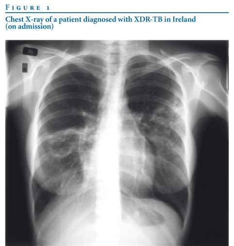 Eurosurveillance Extensively Drug Resistant Tuberculosis First Report Of A Case In Ireland