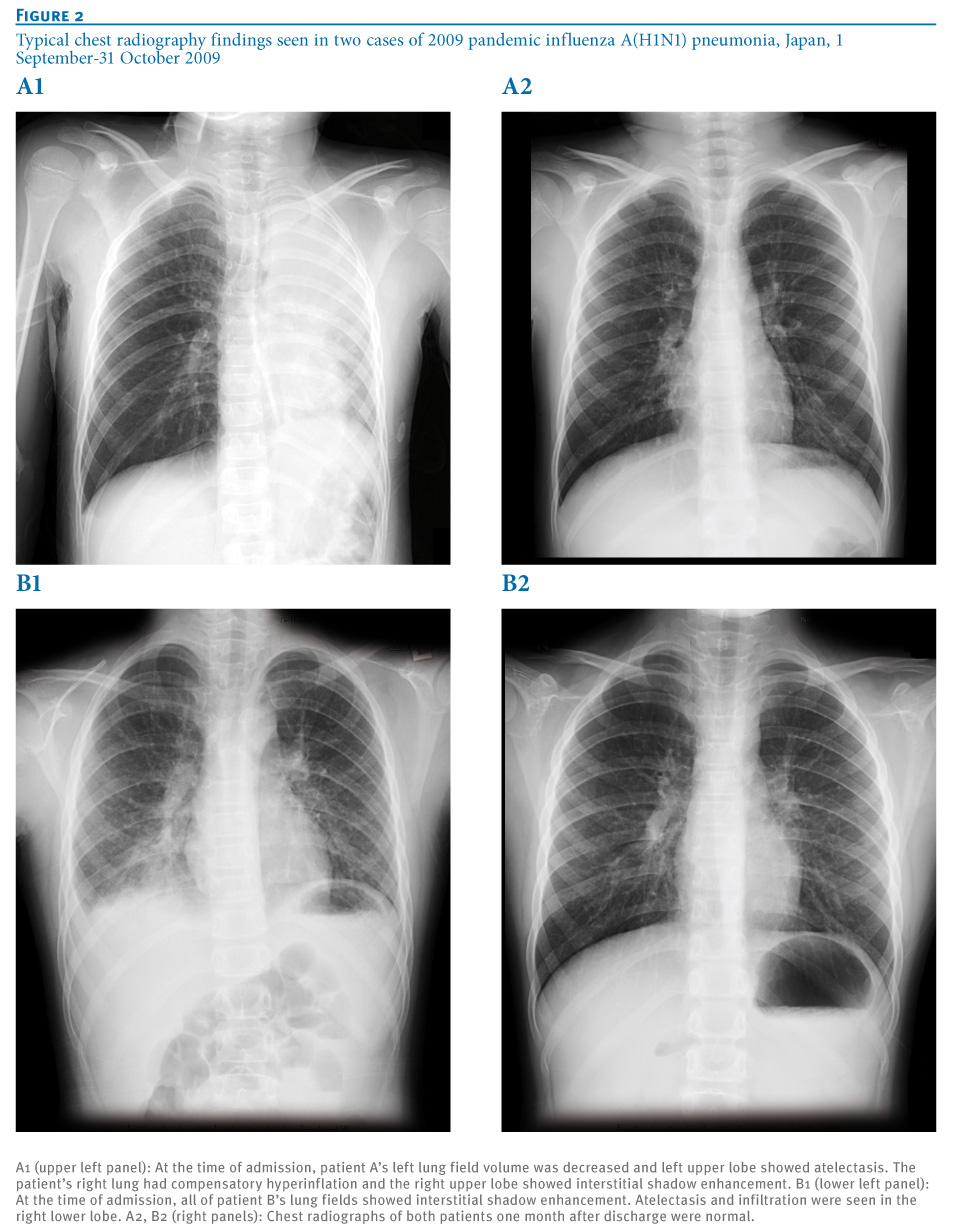 difference-between-bronchitis-and-pneumonia-on-x-ray-slide-share